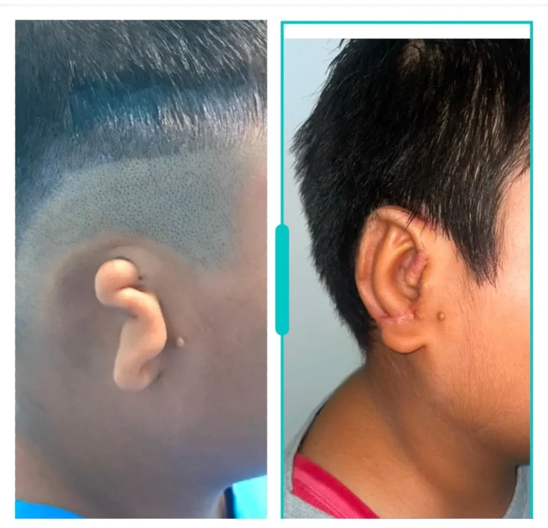 Pre-surgical ear marking before microtia reconstruction procedure