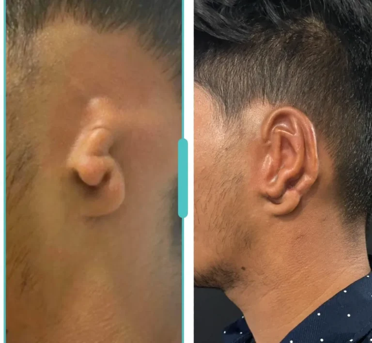 Microtia correction surgery before and after treatment result