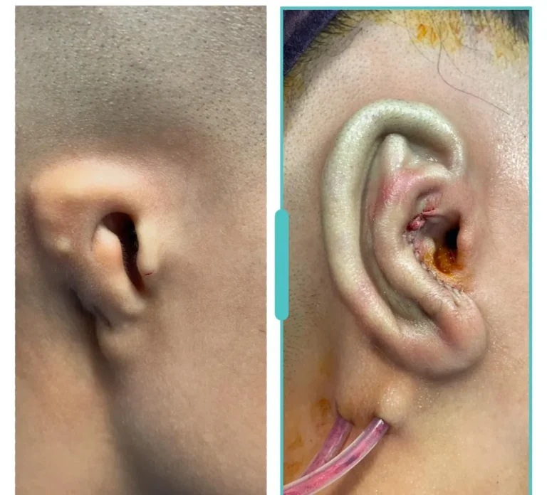 Microtia ear reconstruction surgery showing framework and immediate surgical result