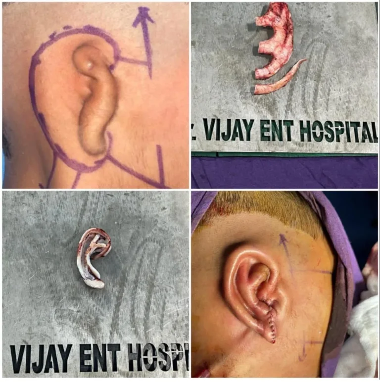 Before and after ear deformity correction surgery result