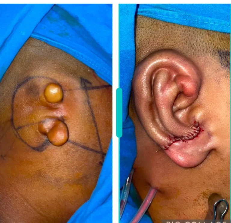 Microtia ear deformity treatment case showing before and after reconstruction