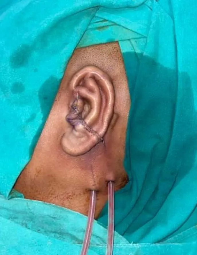 Microtia ear surgery case with immediate reconstructed ear result