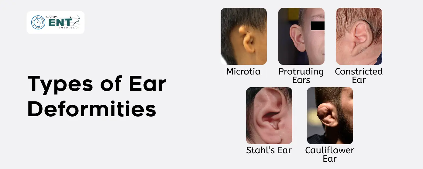Types of Ear Deformities