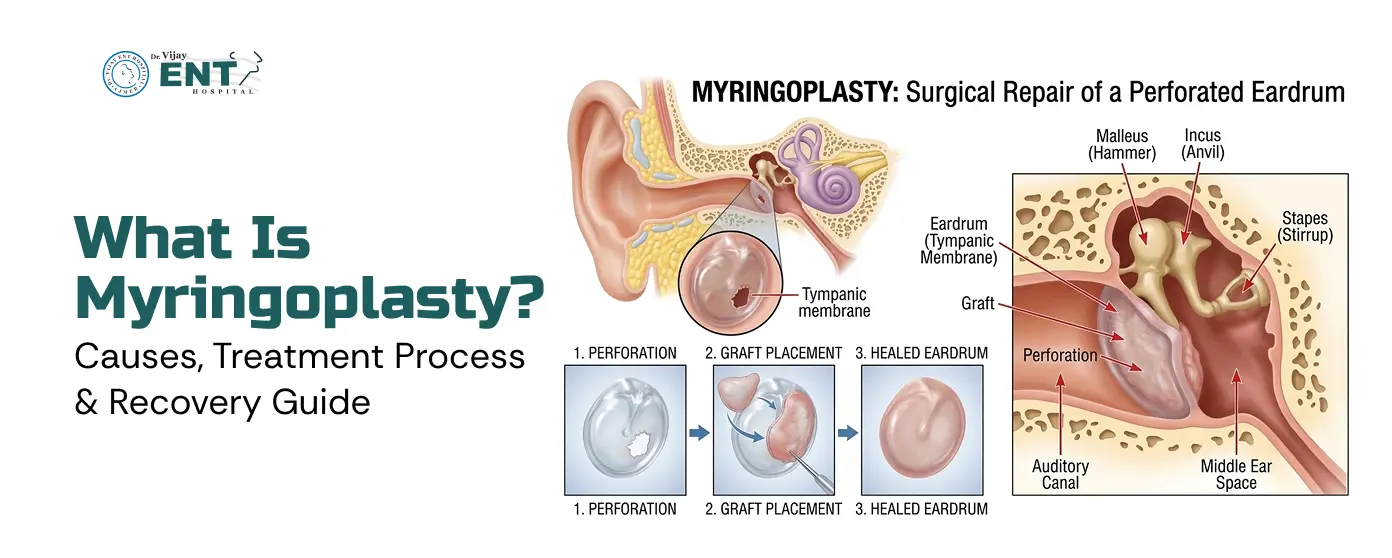 What Is Myringoplasty? Causes, Treatment Process & Recovery Guide