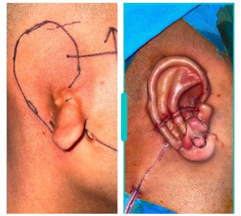 Ear marking before microtia correction surgery for outer ear reconstruction