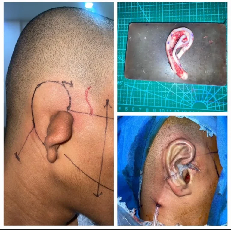 Pre-operative surgical marking for ear reconstruction treatment