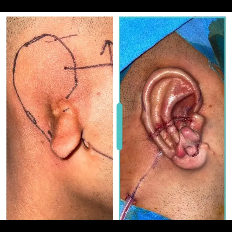 Before and after microtia ear reconstruction surgery showing improved outer ear shape