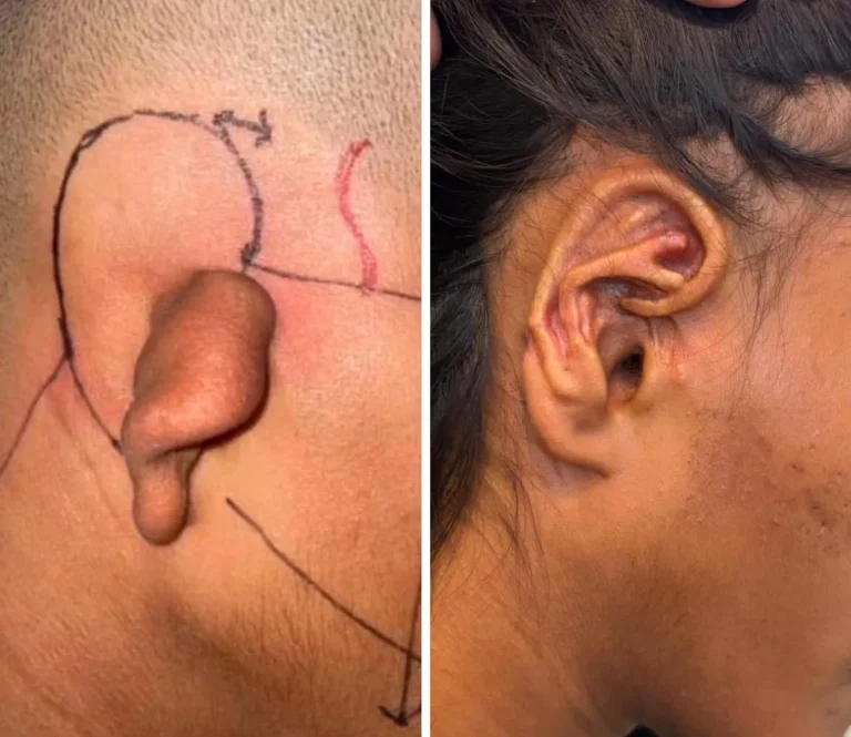 Ear reconstruction case showing microtia correction and post-surgery appearance