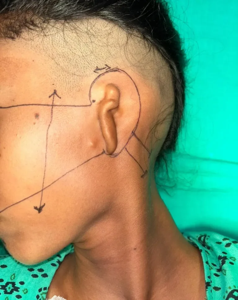 Pre-operative marking and immediate post-operative result of ear reconstruction surgery
