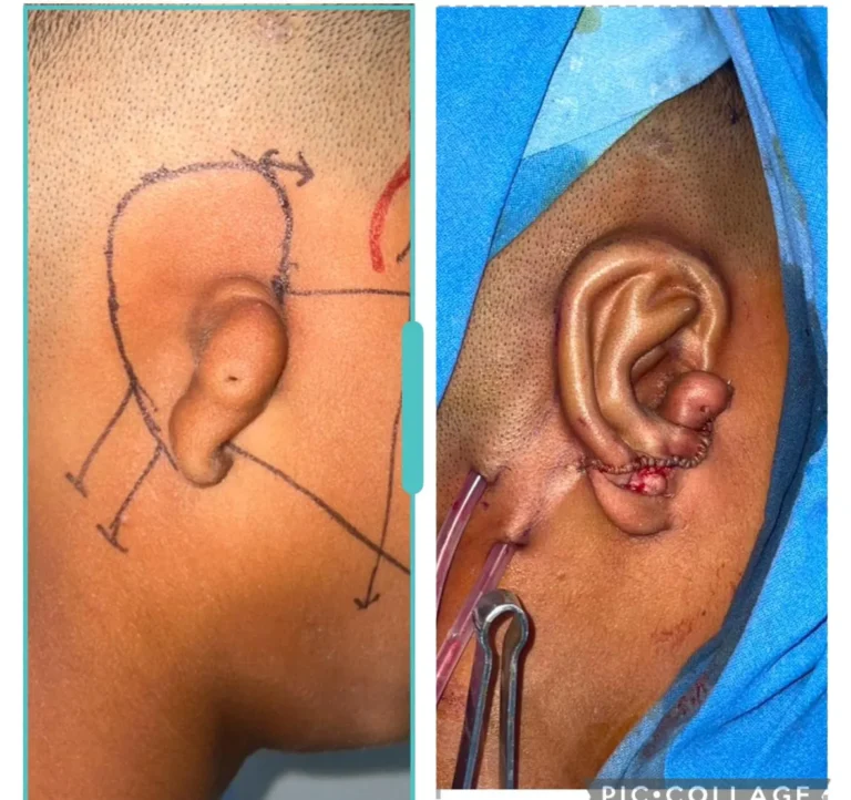 Post-operative result after reconstructive ear surgery