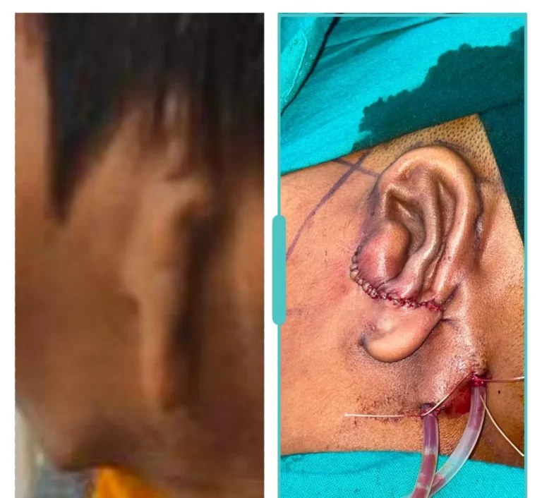 ENT reconstructive ear surgery case with post-operative ear shaping