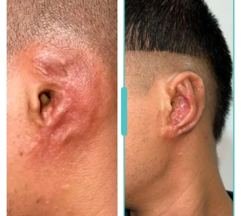 Before and after microtia surgery showing reconstructed outer ear
