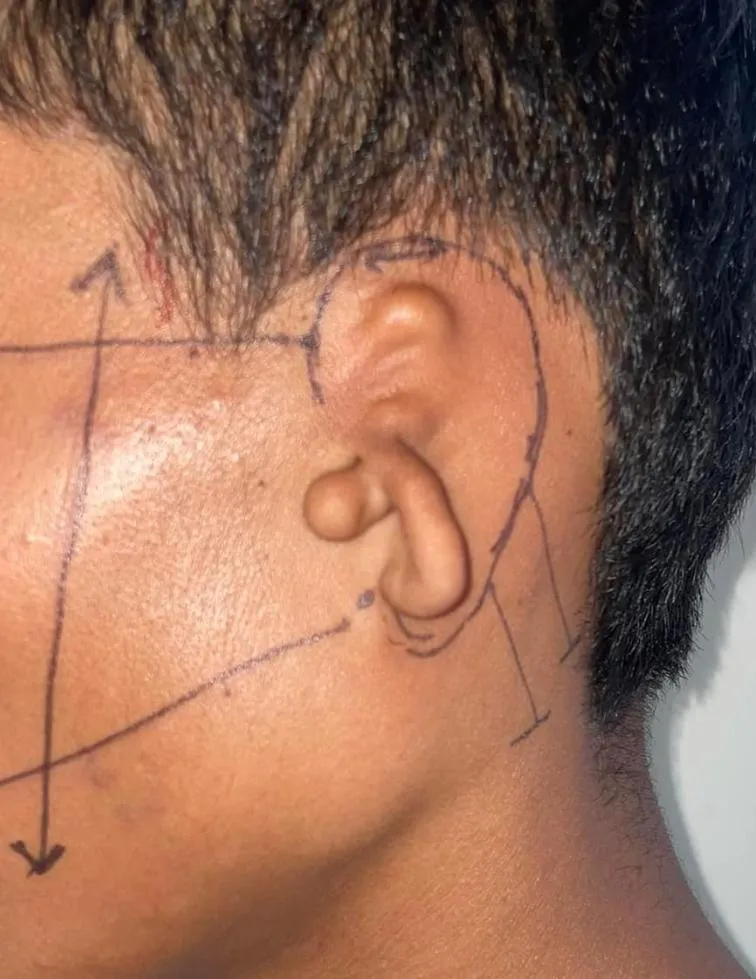 Microtia case showing congenital small ear before reconstruction surgery