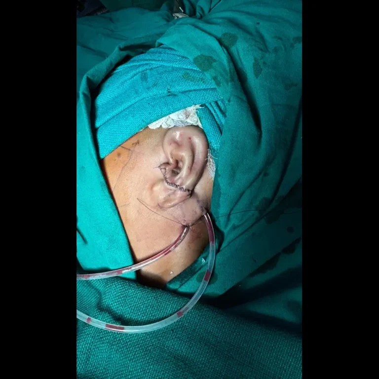 Ear deformity treatment before and after result showing reconstructed external ear