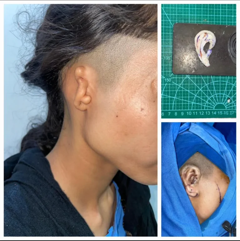 Microtia ear reconstruction surgery with immediate post-operative result