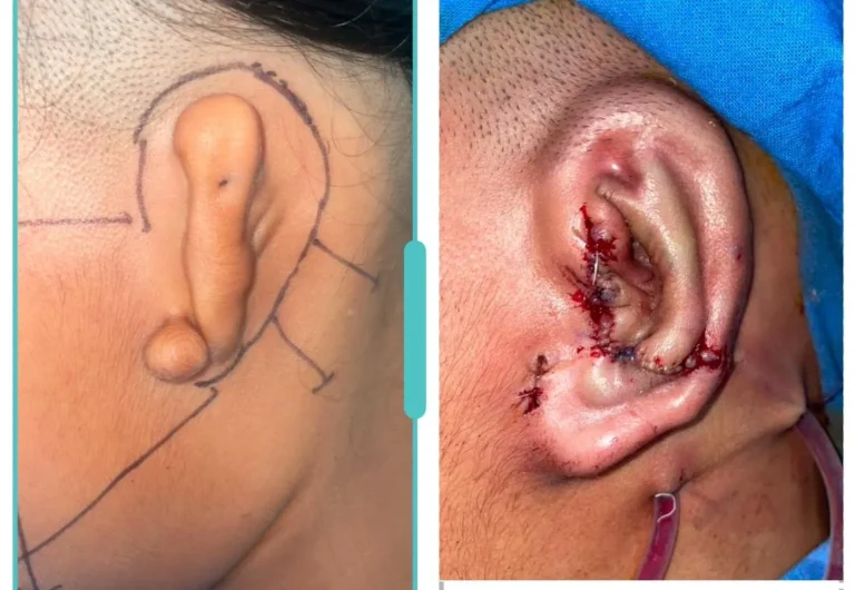 Pre-operative marking for microtia ear surgery and reconstruction planning