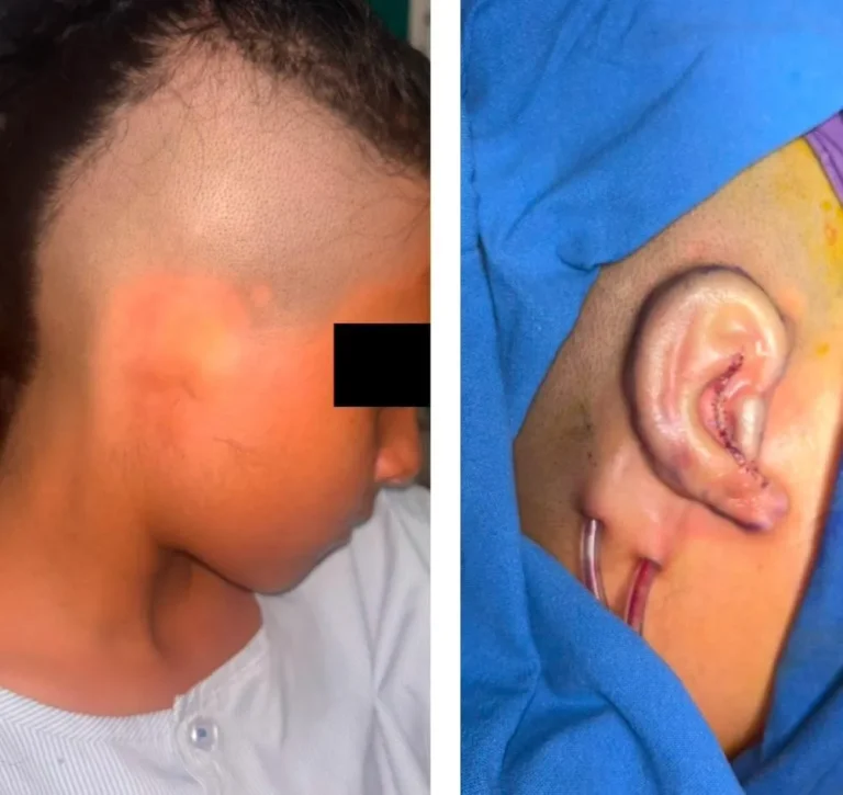 Microtia surgery case in India showing ear reconstruction outcome