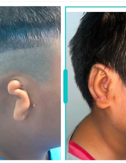 Before and After Congenital Ear Deformity Correction – Reconstructive Ear Surgery Result