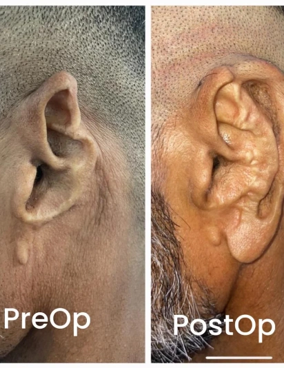 Pre and post operative ear surgery result showing improved ear shape and correction of deformity