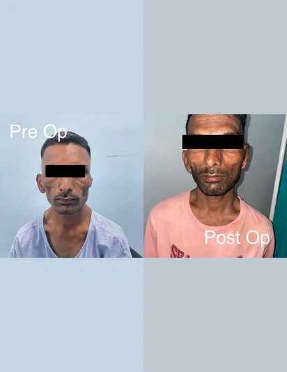 Pre-operative and post-operative front-view comparison of a male patient showing facial symmetry improvement after ear reconstruction surgery for microtia.
