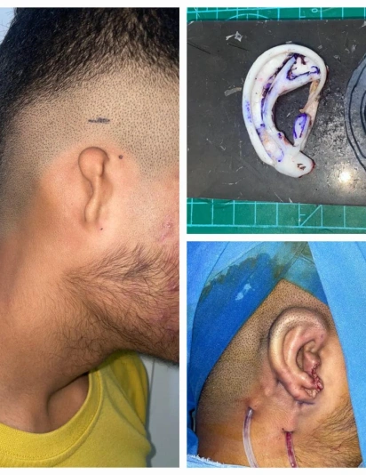 Before and after images of ear reconstruction surgery showing a preoperative ear deformity and immediate postoperative reconstructed ear with sutures.