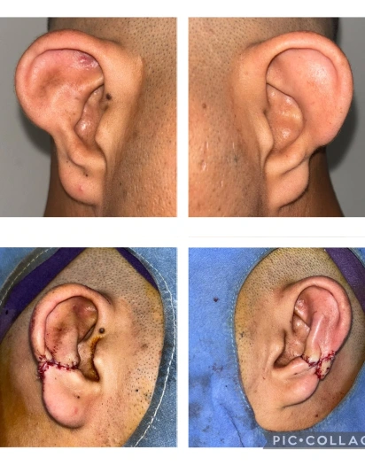 Before and after preauricular sinus surgery showing infected sinus opening and post-surgical healed ear area