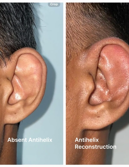 Before and after close-up images of an ear showing absent antihelix before surgery and antihelix reconstruction after ear correction procedure.