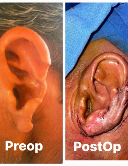ear reconstruction surgery showing a preoperative ear deformity and immediate postoperative reconstructed ear with sutures.