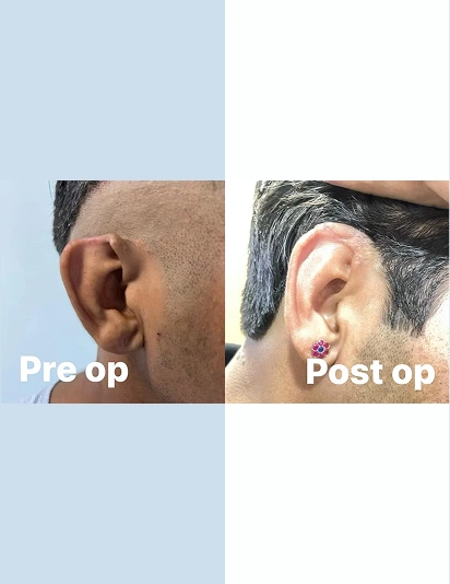 Before and after ear surgery comparison showing natural-looking results and better ear symmetry