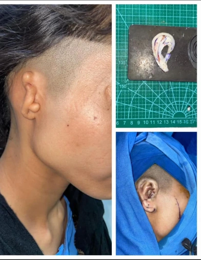 Visual case of ear reconstruction showing initial ear deformity, surgical process, and improved ear appearance