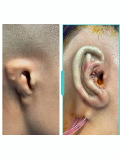 Microtia Ear Reconstruction – Preoperative Deformity and Immediate Postoperative Result