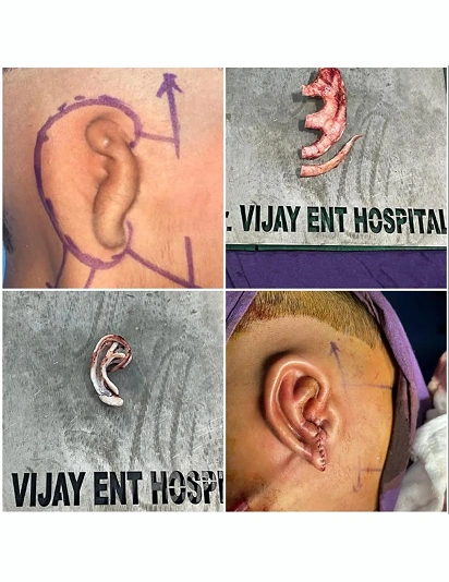 Microtia ear reconstruction surgery process showing pre-surgical marking, ear framework, and post-surgery