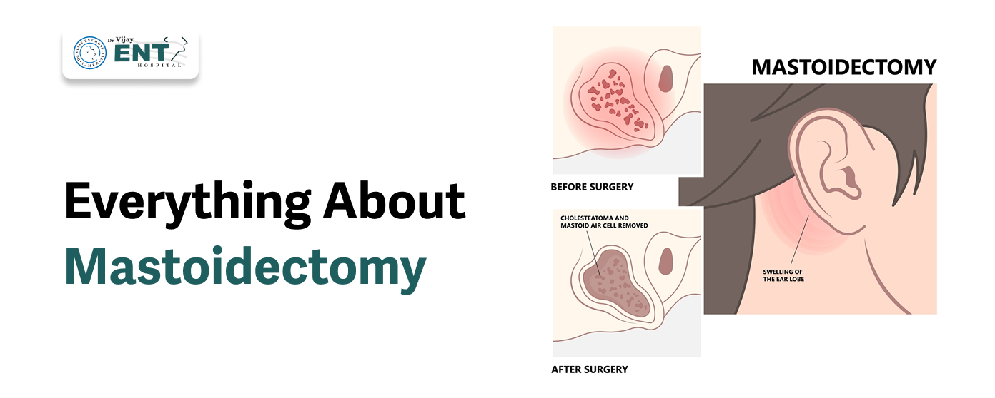 Everything About Mastoidectomy