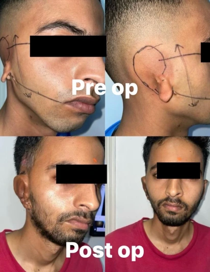 Before and after ear surgery comparison showing natural-looking results and better ear symmetry