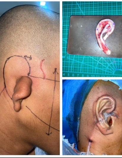 Step-by-step ear reconstruction surgery including surgical planning, cartilage graft shaping, and final ear reconstruction