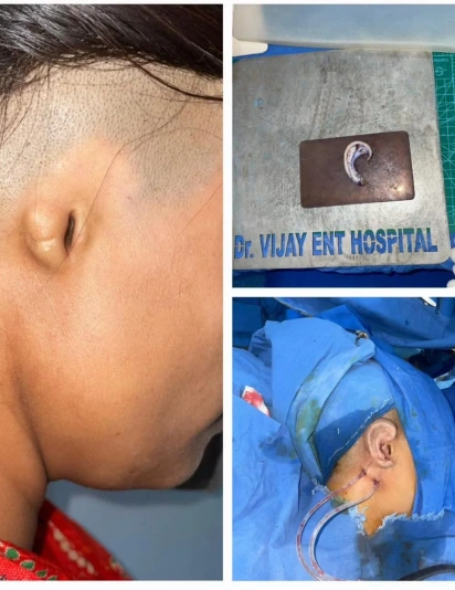 Ear reconstruction surgery showing underdeveloped ear condition, cartilage framework model, and surgical procedure in operation theater