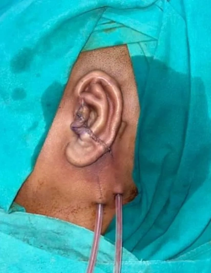 Immediate post-operative view of reconstructed ear for microtia with sutures and surgical drains in place after ear framework placement.