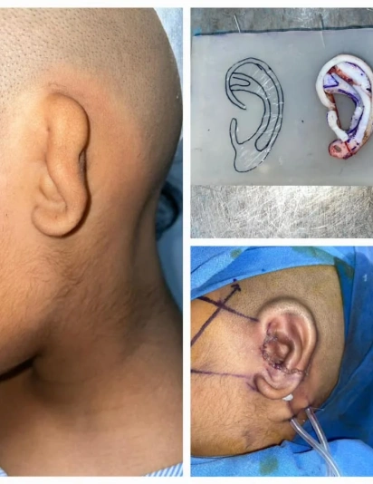 Step-by-step ear surgery including preoperative ear view, cartilage framework design, and surgical reconstruction