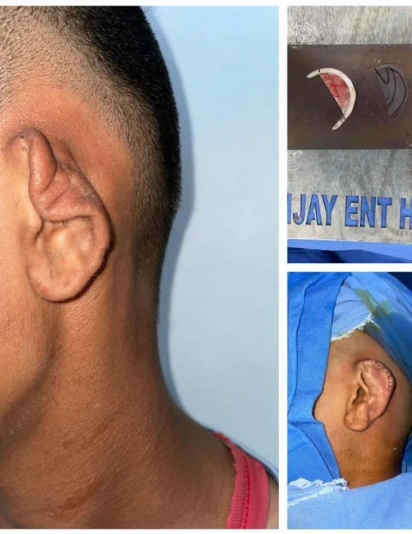 Before and after ear reconstruction surgery showing cartilage graft preparation, surgical procedure, and healed ear result