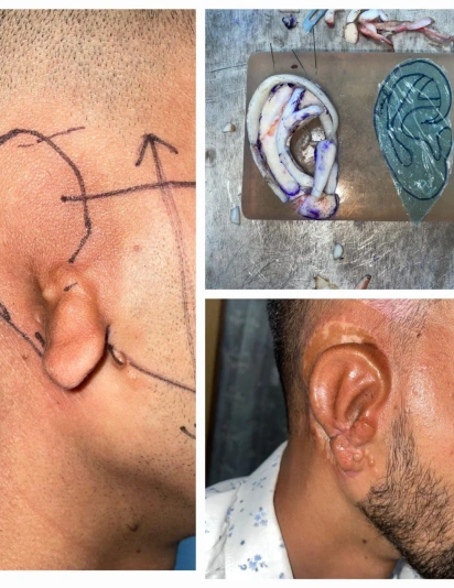 Medical images showing ear reconstruction procedure including surgical planning and final reconstructed ear