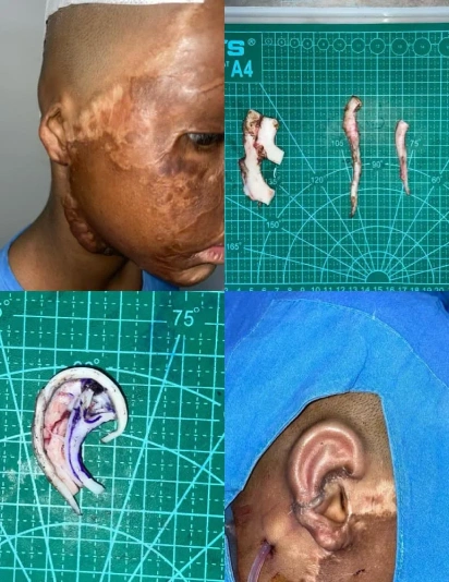Staged ear reconstruction surgery using rib cartilage graft for microtia, showing scarred facial skin, harvested cartilage pieces, ear framework shaping, and final reconstructed ear outcome.