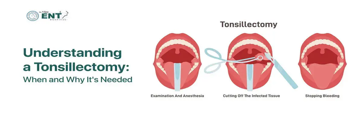 Understanding a Tonsillectomy: When and Why It’s Needed
