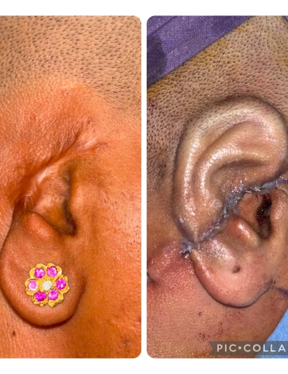 Before and after microtia correction showing underdeveloped ear and surgically reconstructed natural ear contour with sutures
