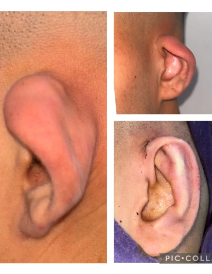 Microtia Patient Before and After Surgery