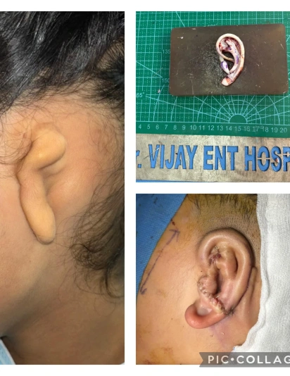 Before and after microtia ear reconstruction surgery showing a malformed outer ear and the surgically reconstructed natural-shaped ear by an ENT specialist