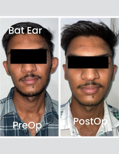 Before and after photos of a male patient showing correction of bat ears with ear surgery, labeled pre-operative and post-operative results.