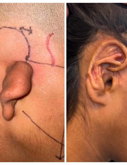 Microtia Ear Surgery Before and After Results