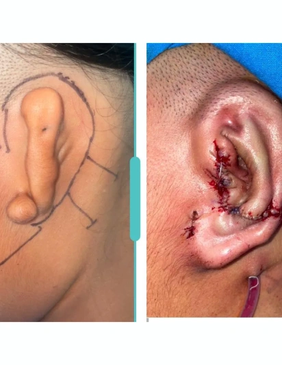 Microtia ear surgery showing pre-operative ear marking and post-operative stitched ear reconstruction result