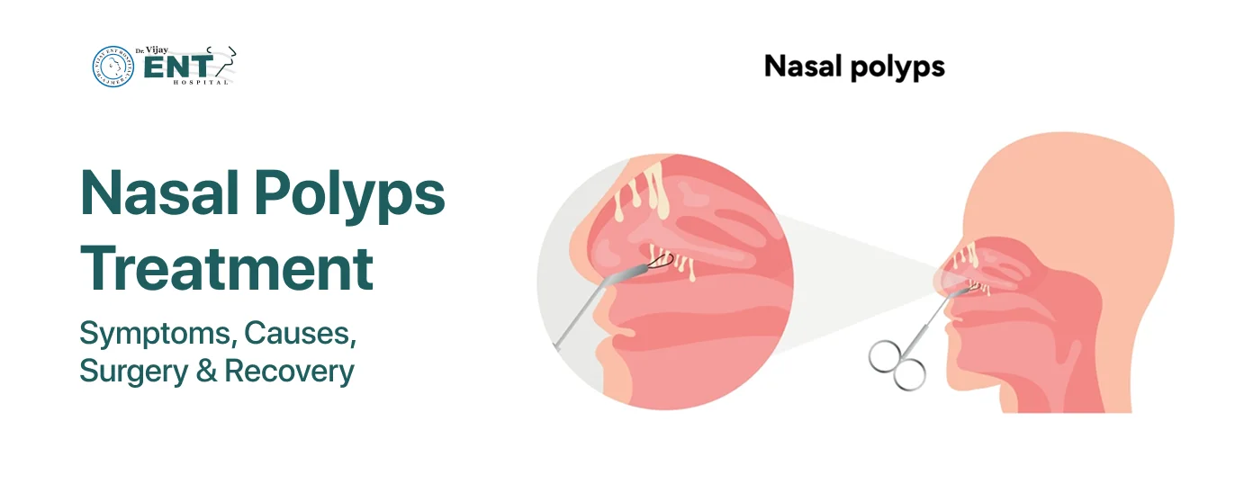 What are Nasal Polyps? Symptoms, Causes, and Treatment Process